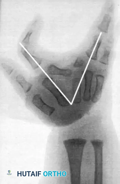 Radiographic divergence measurement after reconstruction