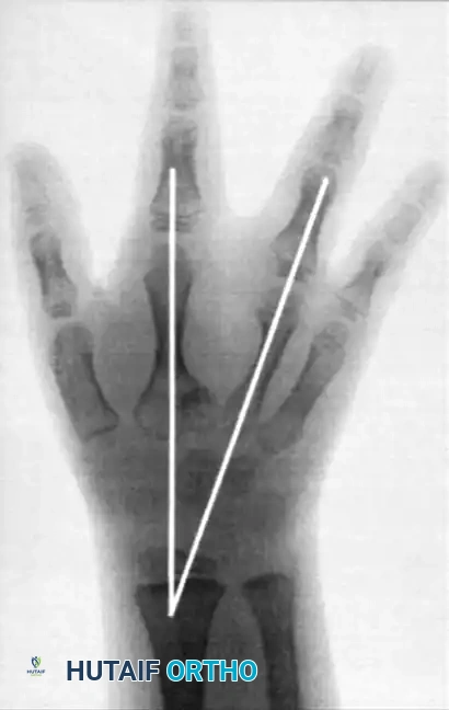 Radiographic divergence measurement after reconstruction