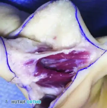 Manske and Halikis Type 3