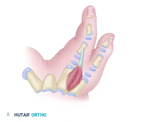 Manske and Halikis Type 4