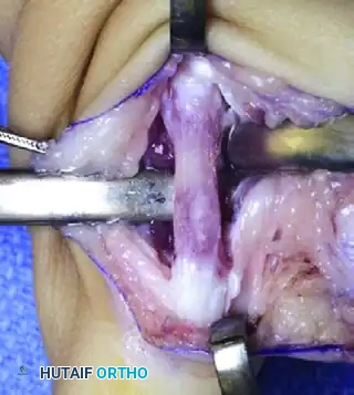 Manske and Halikis Type 2