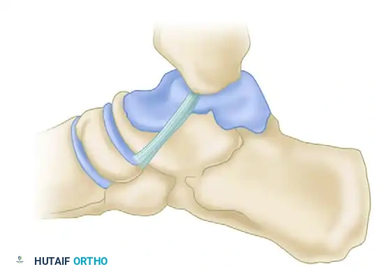 FIGURE 54-10 When deltoid ligament has been avulsed from its distal insertion, it may become reflected proximally and allow posterior tibial tendon to become interposed as shown. Sponta neous healing of ligament is impaired.