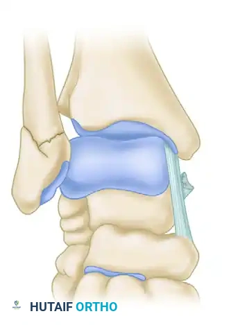 FIGURE 54-10 When deltoid ligament has been avulsed from its distal insertion, it may become reflected proximally and allow posterior tibial tendon to become interposed as shown. Sponta neous healing of ligament is impaired.