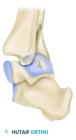 TRIMALLEOLAR FRACTURE Surgical Diagram
