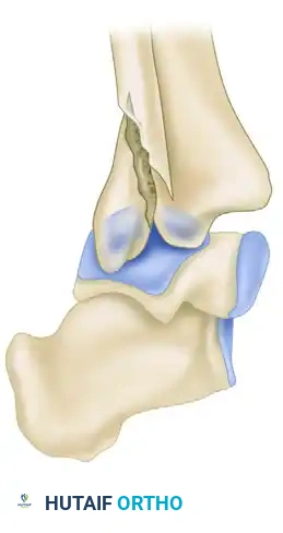 TRIMALLEOLAR FRACTURE Surgical Diagram