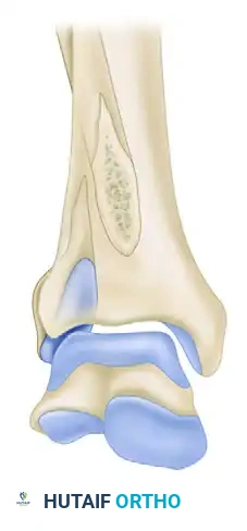TRIMALLEOLAR FRACTURE Surgical Diagram