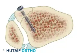 TRIMALLEOLAR FRACTURE Surgical Diagram
