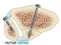 TRIMALLEOLAR FRACTURE Surgical Diagram