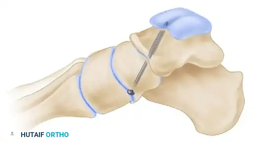 استخدام المباعدات الجراحية للوصول للمفاصل العميقة