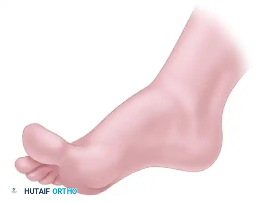 تحضير أسطح المفاصل وإزالة الغضاريف