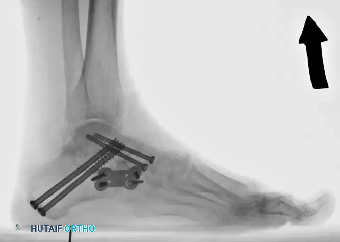 تثبيت المفصل الكاحلي الزورقي بالمسامير