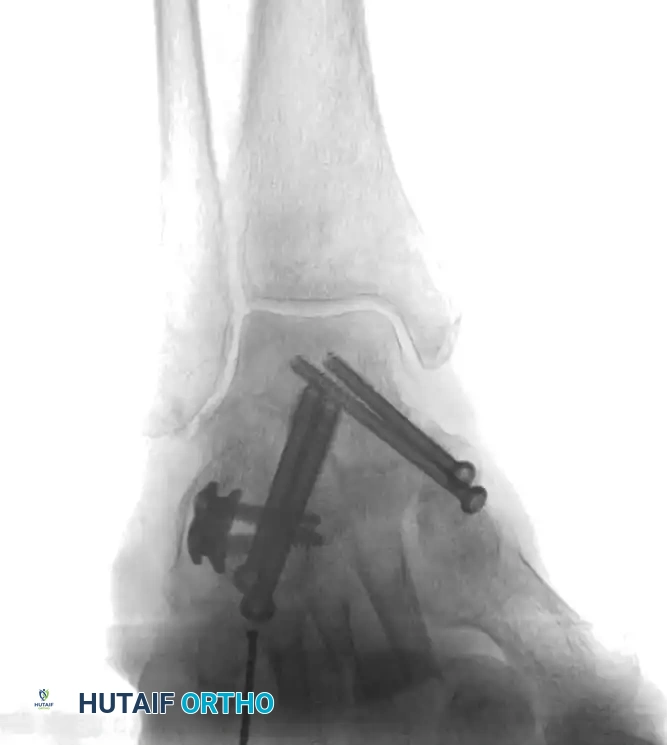 الشكل النهائي للتثبيت والترقيع العظمي