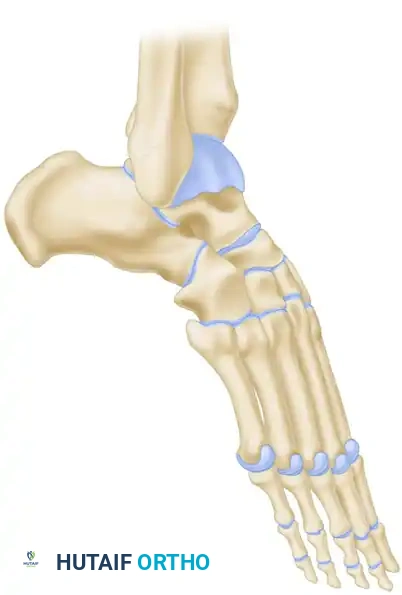 Lambrinudi Arthrodesis - Resection Planning