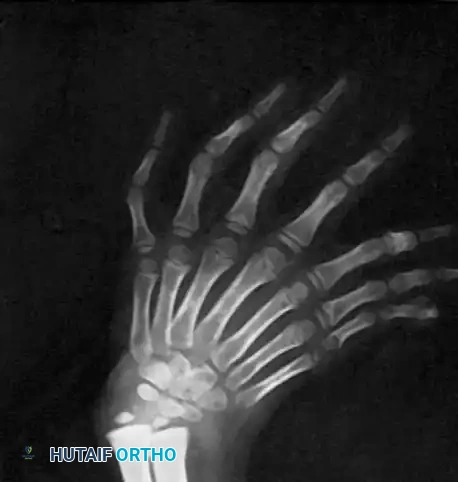 Ulnar Dimelia (Mirror Hand): Pathoanatomy, Biomechanics, and Surgical Reconstruction