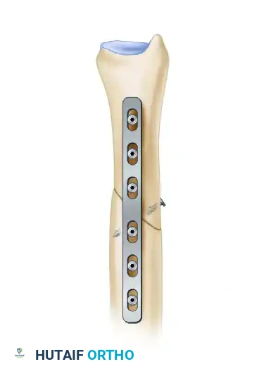 Interfragmentary Lag Screw