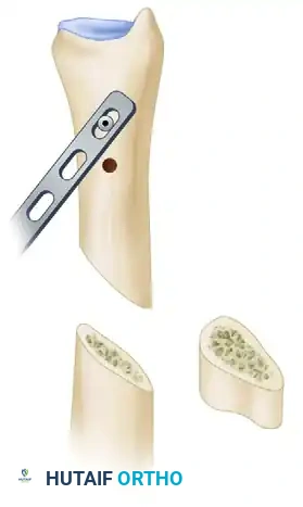 Parallel Osteotomy Cut