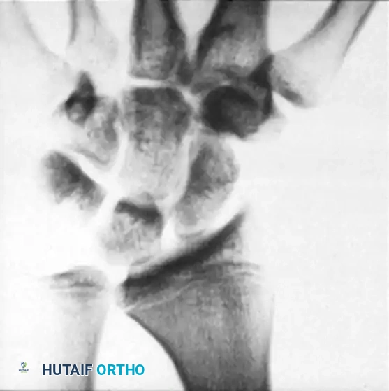 Preoperative Radiograph demonstrating ulnar-positive variance
