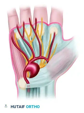 Two types of traumatic aneurysms of ulnar artery in hand. B, “True” fusiform aneurysm of ulnar artery.