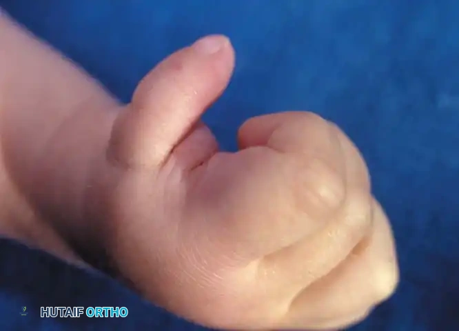 Comprehensive Surgical Management of Congenital Thumb Hypoplasia and Undergrowth Deformities