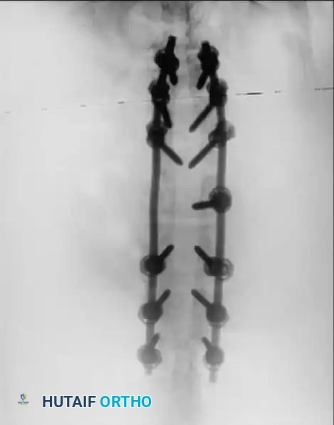 UNUSUAL CAUSES OF KYPHOSIS Surgical Diagram