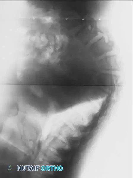 UNUSUAL CAUSES OF KYPHOSIS Surgical Diagram