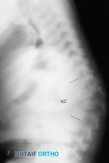 UNUSUAL CAUSES OF KYPHOSIS Surgical Diagram