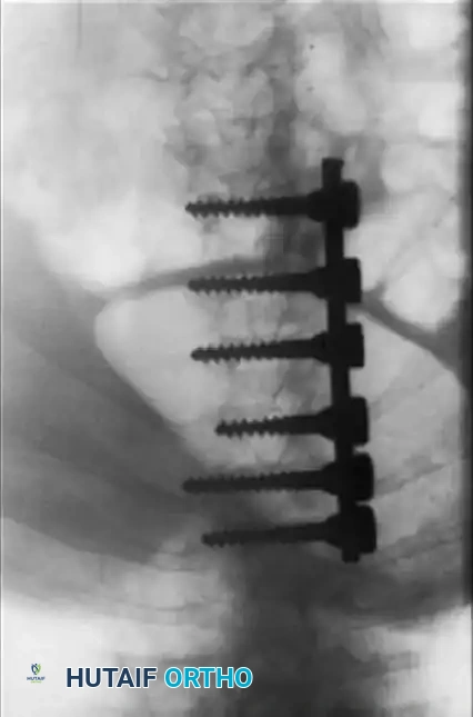 UNUSUAL CAUSES OF KYPHOSIS Surgical Diagram