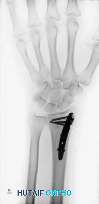 VOLAR OSTEOTOMY Surgical Diagram