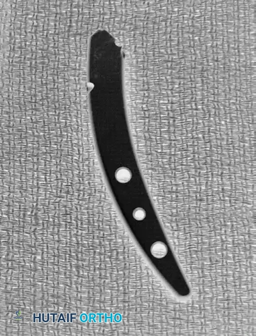 VOLAR OSTEOTOMY Surgical Diagram