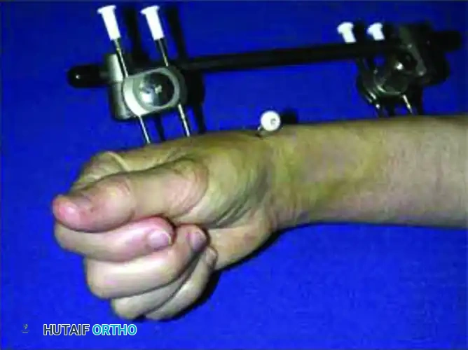 External fixation clinical application 2