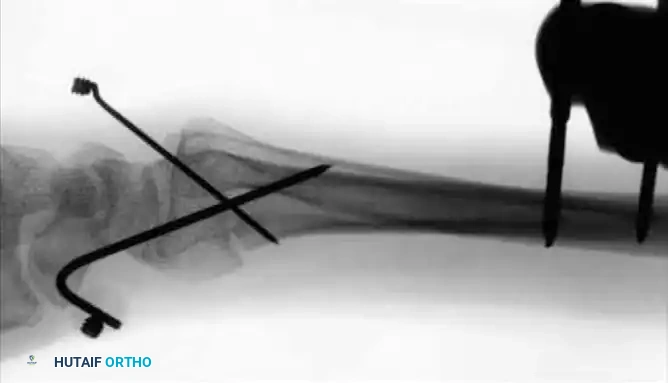 Crossed-pin augmentation radiograph 2