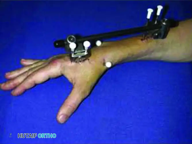 External fixation clinical application 1