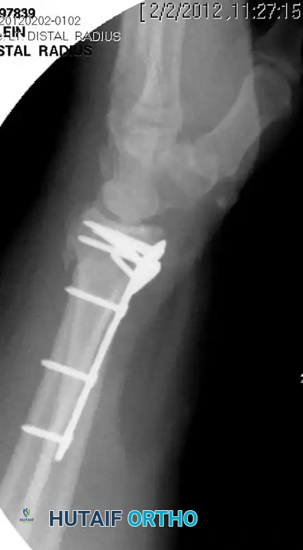 Volar Plate Fixation Lateral Radiograph