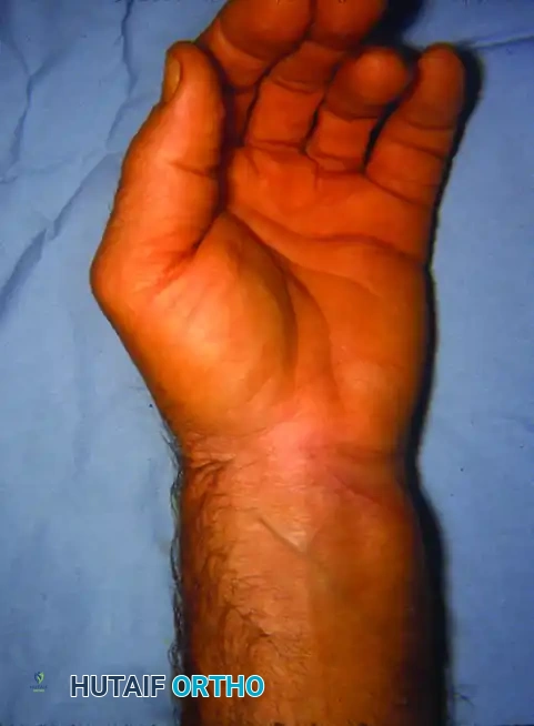 Rheumatoid Wrist Reconstruction: Volar Synovectomy and Arthroplasty Masterclass