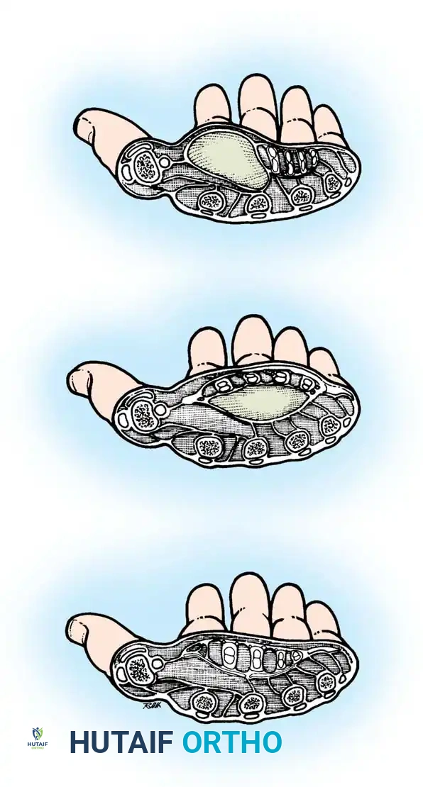 Abscess in thenar space