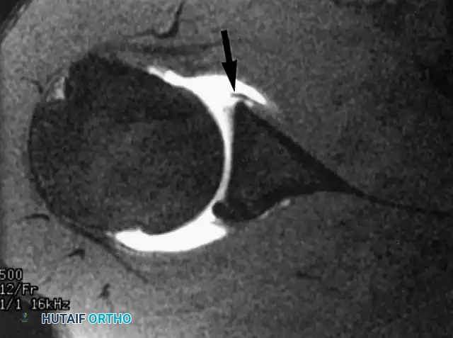 Fig. 2-30 Labral tear at MRI arthrography. On axial T1weighted image, small, avulsed anterior labral fragment is displayed as linear low-signal abnormality (arrow) surrounded by high-signal gadolinium.