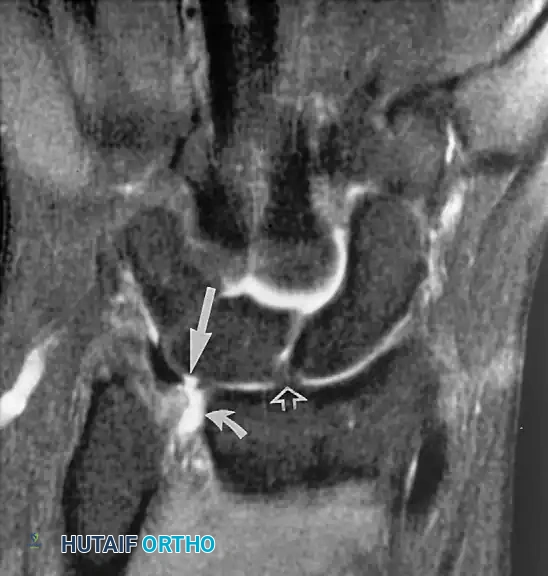 Fig. 2-33 Triangular fibrocartilage perforation. Coronal fatsuppressed, proton density–weighted image of wrist shows central perforation of triangular fibrocartilage (long arrow). Note fluid in distal radioulnar joint (curved arrow). Scapholunate ligament (open arrow) is intact in this wrist.