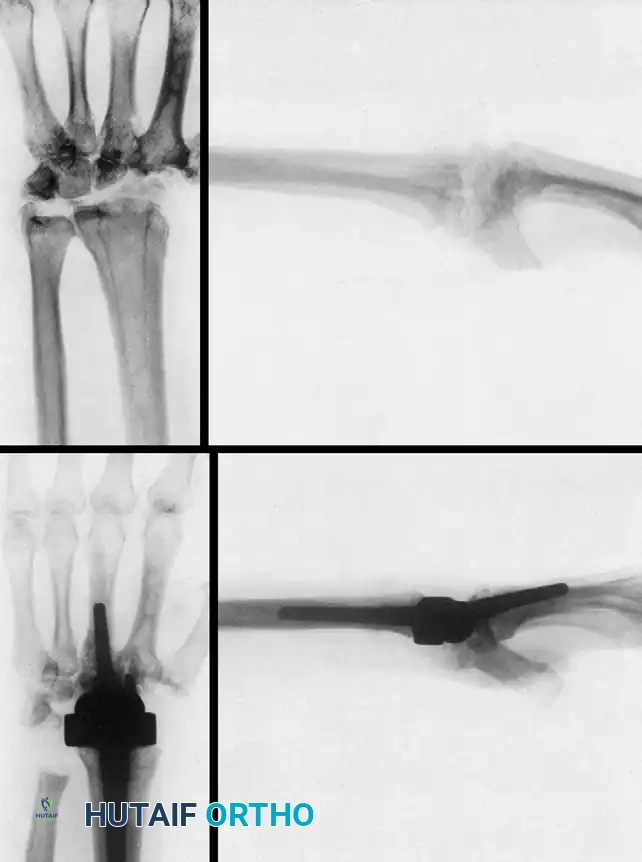 WRIST ARTHRODESIS AND ARTHROPLASTY Surgical Diagram