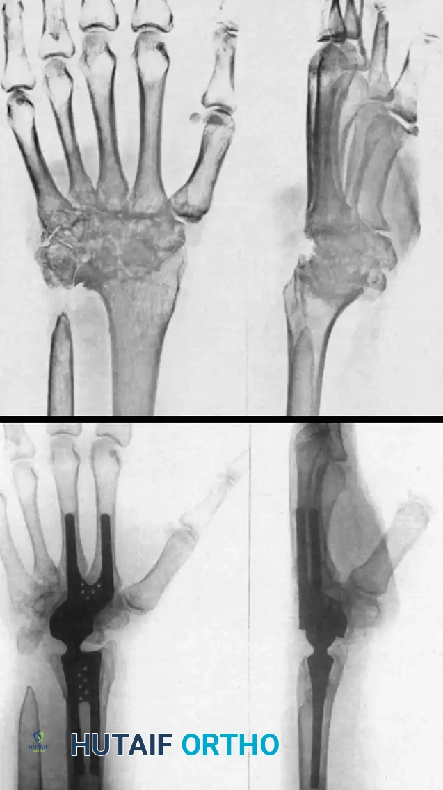 WRIST ARTHRODESIS AND ARTHROPLASTY Surgical Diagram