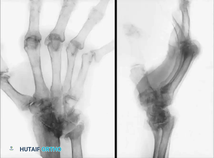 WRIST ARTHRODESIS AND ARTHROPLASTY Surgical Diagram