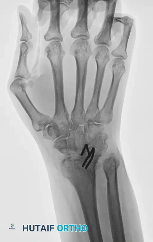 WRIST ARTHRODESIS AND ARTHROPLASTY Surgical Diagram