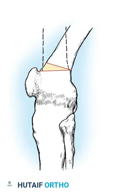 عملية قطع العظم الإسفيني الأمامي لتصحيح انثناء الركبة الشديد