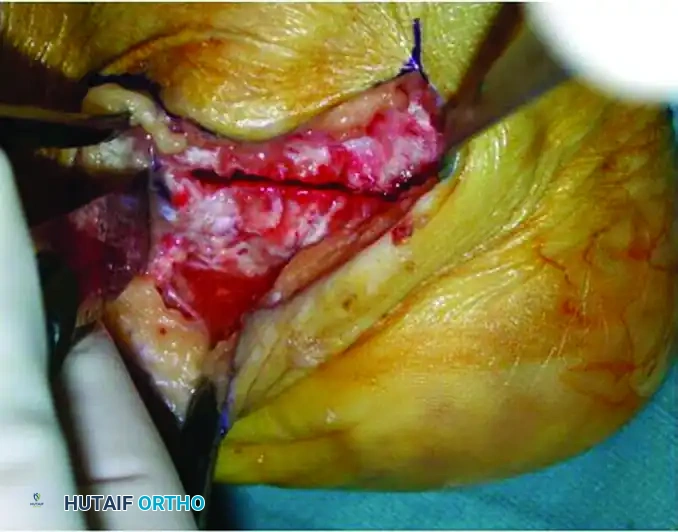 Z -SHAPED CALCANEAL OSTEOTOMY Surgical Diagram