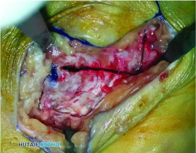Z -SHAPED CALCANEAL OSTEOTOMY Surgical Diagram