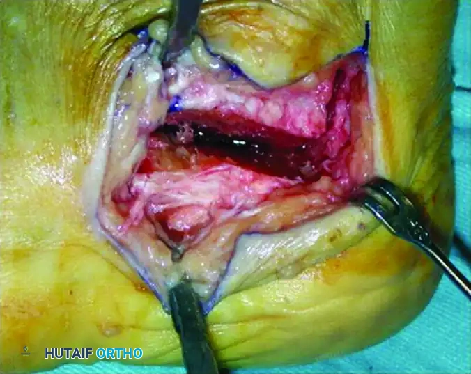 Z -SHAPED CALCANEAL OSTEOTOMY Surgical Diagram