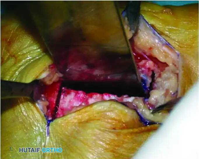 Z -SHAPED CALCANEAL OSTEOTOMY Surgical Diagram