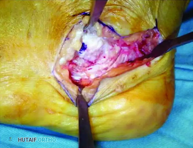 Z -SHAPED CALCANEAL OSTEOTOMY Surgical Diagram