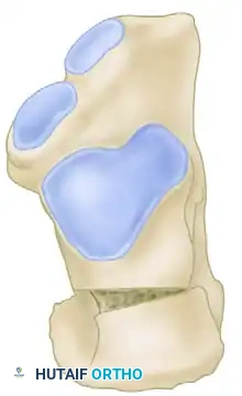 Z -SHAPED CALCANEAL OSTEOTOMY Surgical Diagram