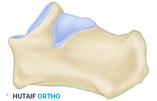 Z -SHAPED CALCANEAL OSTEOTOMY Surgical Diagram