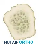 Z -SHAPED CALCANEAL OSTEOTOMY Surgical Diagram